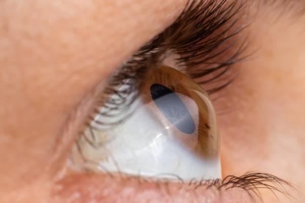 Cornea Treatment in Wakad | Cornea Services - Clairevision Eye Hospital