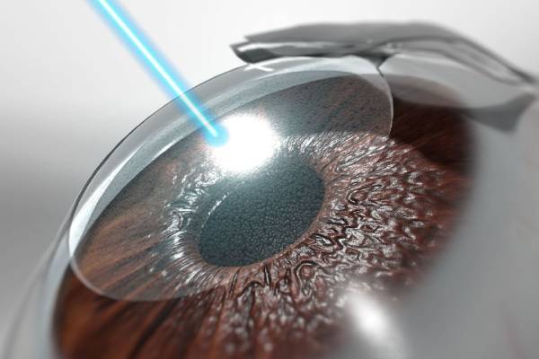 Refractive Surgery(LASIK&ICL) - Clairevision Eye Hospital