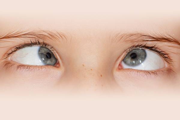 Squint Correction -Pediatric Eye CheckUp