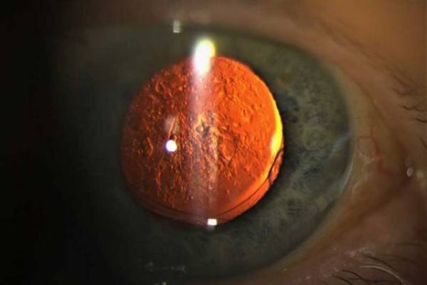 LASIK Surgery | Laser Eye Surgery in Pune - Yag Laser Capsulotomy: