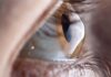 Understanding Keratoconus Symptoms, Causes, and Diagnosis - Clairevision Eye Care